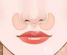 鼻翼外切后需要多長(zhǎng)時(shí)間恢復(fù)?