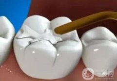 補(bǔ)牙是不是*性的？