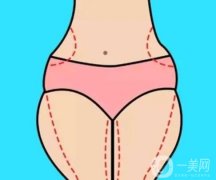 小腿抽脂疼嗎？恢復(fù)需要多長時間？