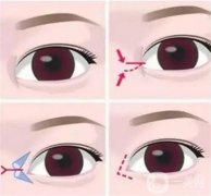 做全切雙眼皮有什么注意事項(xiàng)