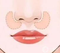 鼻基底填充手術的操作流程是怎么樣的？
