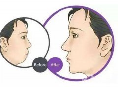 玻尿酸豐下巴有什么后遺癥？