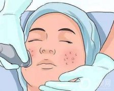 對祛痘印做彩光嫩膚有嗎？