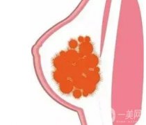 奧美定是什么？取出后的殘留物取會致癌嗎