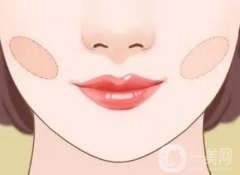 雙下巴吸脂的果可以維持多久?