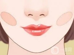 什么是頰脂墊？為什么要做頰脂墊？