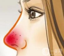 哪些因素影響酒渣鼻整形的價(jià)格?