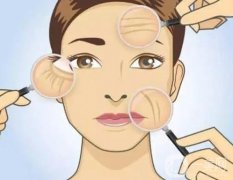 什么是間斷懸吊除皺術(shù),果怎么樣？