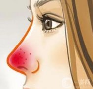 酒渣鼻怎么調(diào)節(jié)？病因是什么？