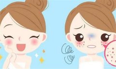 激光祛斑有哪些優(yōu)勢(shì)？