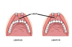 唇系帶整形手術(shù)的方法和步驟？
