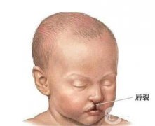 胎兒唇裂的原因及修復(fù)方法？