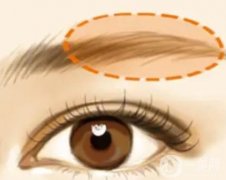 有哪些常見的眉弓整形方法？