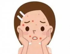 激光祛痘的原理是什么?術(shù)后如何護(hù)理?快來(lái)看看吧