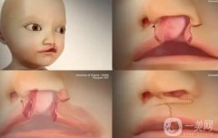 唇腭裂修復手術步驟