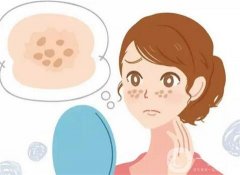 蝴蝶斑調節(jié)方法有哪些?