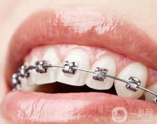 固定矯治器調(diào)節(jié)的優(yōu)勢？注意事項(xiàng)？