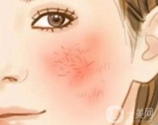 激光去除紅血絲術(shù)后如何護(hù)理？痛不痛？