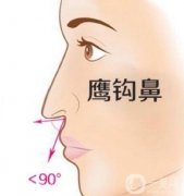 矯正鷹鉤鼻需要假體嗎？鷹鉤鼻矯正的方法？