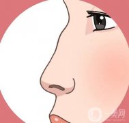 駝峰鼻矯正有哪些后遺癥？如何降低駝峰鼻矯正的風(fēng)險？