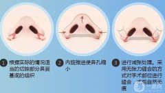 如果鼻翼縮小手術(shù)失敗了怎么辦？鼻翼縮小手術(shù)是如何進(jìn)行的？