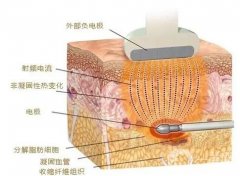 射頻緊膚適合哪些人群？果怎么樣？
