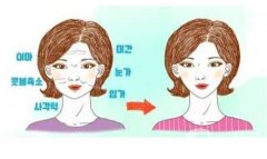 如果做熱瑪吉臉部凹陷怎么辦？如何預(yù)防？