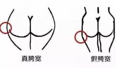 假胯寬能不能抽脂？如何判斷自己是不是假胯寬？