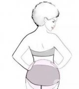 腰部抽脂有沒有風(fēng)險？