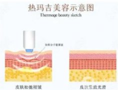 熱瑪吉和其他雙極或多極射頻之間有什么區(qū)別？