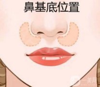 如何填充鼻基底凹陷才不會老？