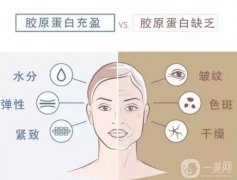 膠原蛋白注射后果能持續(xù)多久？膠原蛋白和玻尿酸的區(qū)別？