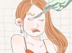 埋線雙眼皮是不是長期性的？需要抽脂嗎？