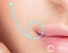 嘴角上揚(yáng)手術(shù)適合誰？有什么危害