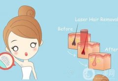 脫毛儀具體使用壽命是多久？多久使用一次？