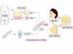 自體脂肪填充有哪些問題？