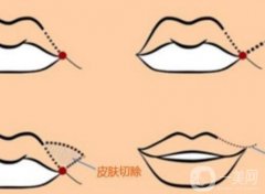 嘴角上揚手術會不會留疤？恢復期是多久？