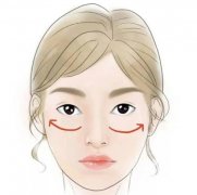 什么是自體脂肪填充？填充后應(yīng)注意什么？