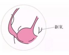 副乳切除會影響母乳喂養(yǎng)嗎？