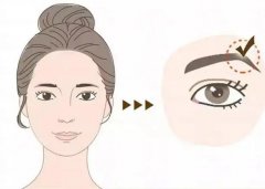 導(dǎo)致眉弓填充不均勻的原因？