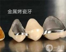 烤瓷牙有哪些注意事項(xiàng)？適合烤瓷牙的人群有哪些？