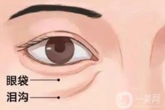 淚溝填充失敗了應(yīng)該怎么辦？玻尿酸填充淚溝術(shù)的優(yōu)點(diǎn)有哪些？