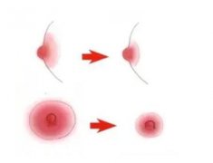 男性可以做乳暈縮小手術(shù)嗎？