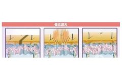 像素激光和點(diǎn)陣激光有哪些區(qū)別？