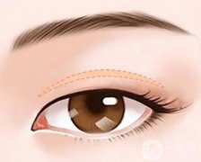 提上瞼肌縮短會(huì)導(dǎo)致哪些后遺癥？