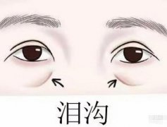 自體脂肪填充淚溝可以保持多長(zhǎng)時(shí)間？