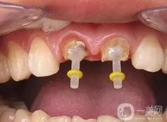 什么是樁核冠修復(fù)？有什么優(yōu)勢(shì)