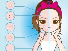 祛斑的果怎么樣？哪些人適合做？