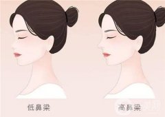 隆鼻有沒有風(fēng)險(xiǎn)？隆鼻材料取出后修復(fù)需要多長時(shí)間？