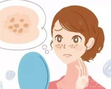 激光去痘印后如何處理抗黑？激光祛痘后的防黑是失敗的嗎？